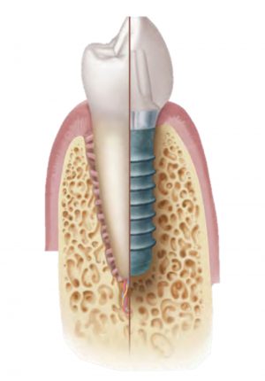 Implantes servicio de odontologia y estomatologia doctor ruiz villandiego hospital quiron donostia 2