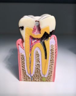 caries en modelo odontologia conservadora dentista urgencias donostia gipuzkoa ruiz villandiego